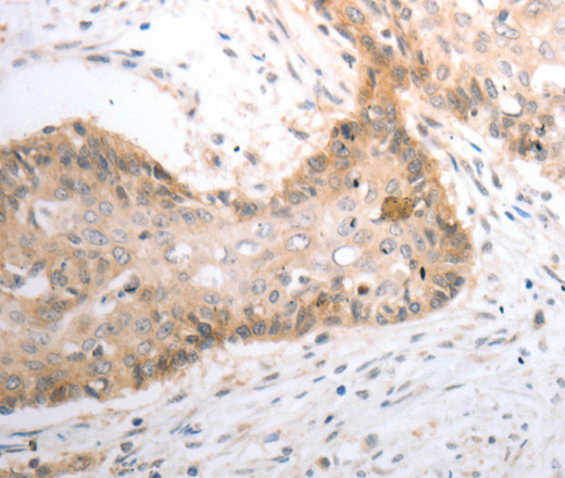 Immunohistochemistry of paraffin-embedded Human cervical cancer using SLC1A4 Polyclonal Antibody at dilution of 1:40