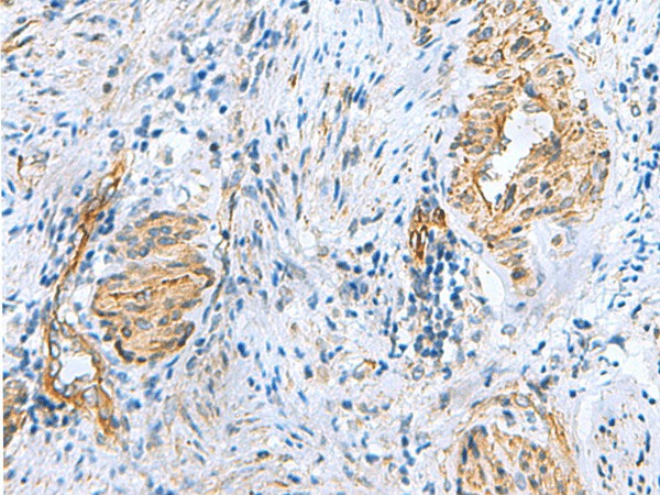 Immunohistochemistry of paraffin-embedded Human cervical cancer tissue  using NMU Polyclonal Antibody at dilution of 1:60(?200)