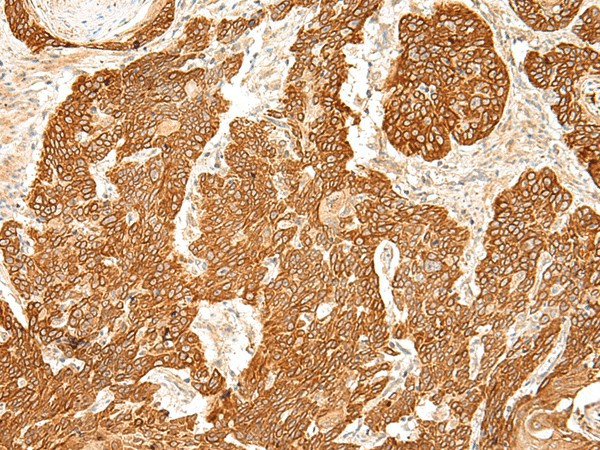 Immunohistochemistry of paraffin-embedded Human esophagus cancer tissue  using SLC6A9 Polyclonal Antibody at dilution of 1:50(?200)