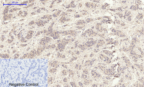 Immunohistochemistry of paraffin-embedded Human liver cancer tissue using MMP2 Polyclonal Antibody at dilution of 1:200.