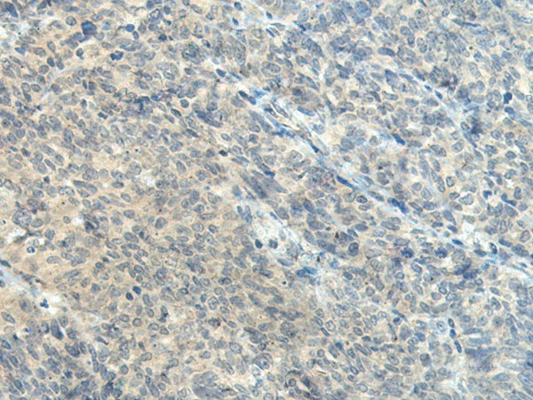 Immunohistochemistry of paraffin-embedded Human ovarian cancer tissue  using CTDP1 Polyclonal Antibody at dilution of 1:55(?200)