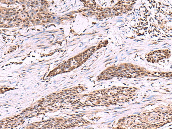 Immunohistochemistry of paraffin-embedded Human esophagus cancer tissue  using CUL4A Polyclonal Antibody at dilution of 1:55(?200)