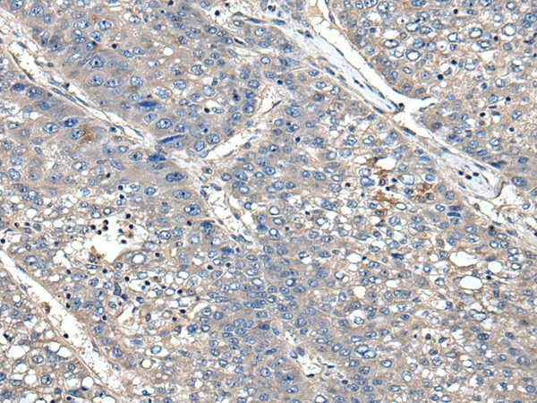 Immunohistochemistry of paraffin-embedded Human liver cancer tissue  using XDH Polyclonal Antibody at dilution of 1:85(?200)