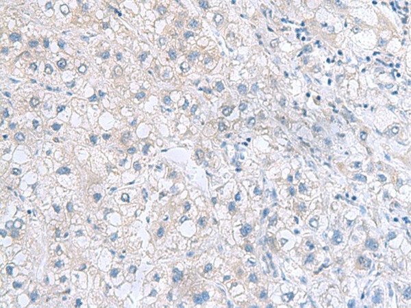 Immunohistochemistry of paraffin-embedded Human liver cancer tissue  using MYDGF Polyclonal Antibody at dilution of 1:70(?200)