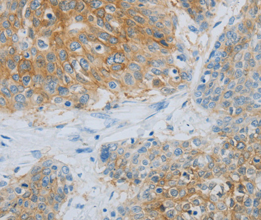 Immunohistochemistry of paraffin-embedded Human esophagus cancer using NDRG1 Polyclonal Antibody at dilution of 1:70