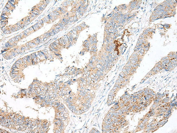 Immunohistochemistry of paraffin-embedded Human colorectal cancer tissue  using GARNL3 Polyclonal Antibody at dilution of 1:60(?200)