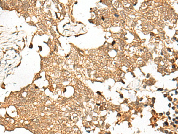 Immunohistochemistry of paraffin-embedded Human lung cancer tissue  using SNAPC5 Polyclonal Antibody at dilution of 1:30(?200)