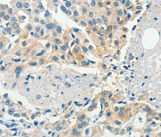 Immunohistochemistry of paraffin-embedded Human breast cancer tissue using DGK beta Polyclonal Antibody at dilution 1:60