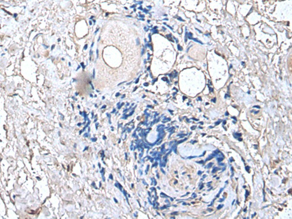 Immunohistochemistry of paraffin-embedded Human thyroid cancer tissue  using PTP4A1 Polyclonal Antibody at dilution of 1:45(?200)