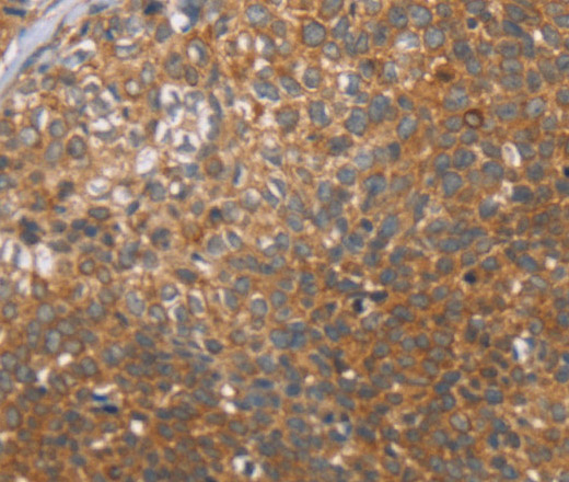 Immunohistochemistry of paraffin-embedded Human cervical cancer tissue using CCL21 Polyclonal Antibody at dilution 1:40