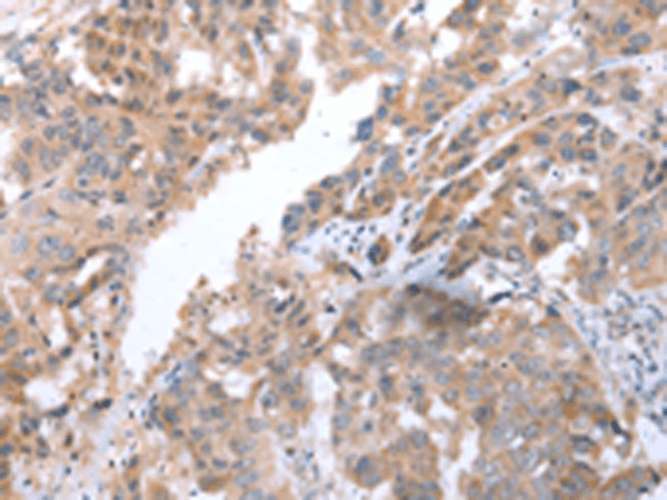 Immunohistochemistry of paraffin-embedded Human breast cancer tissue  using COX7C Polyclonal Antibody at dilution of 1:40(?200)