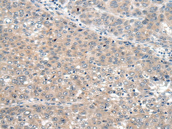 Immunohistochemistry of paraffin-embedded Human liver cancer tissue  using SEMA4D Polyclonal Antibody at dilution of 1:60(?200)