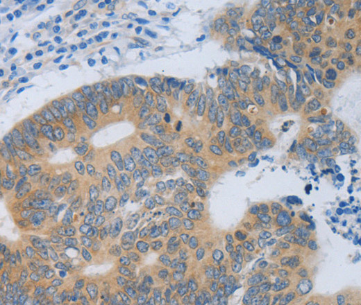 Immunohistochemistry of paraffin-embedded Human colon cancer tissue using MT2A Polyclonal Antibody at dilution 1:40