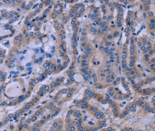 Immunohistochemistry of paraffin-embedded Human thyroid cancer tissue using TUBGCP2 Polyclonal Antibody at dilution 1:50