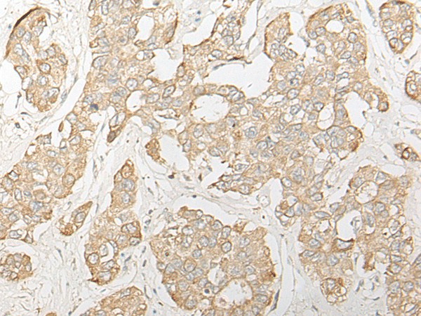 Immunohistochemistry of paraffin-embedded Human liver cancer tissue  using DHRS7 Polyclonal Antibody at dilution of 1:30(?200)