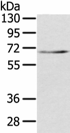 Western Blot analysis of Human lung cancer tissue using TBL1X Polyclonal Antibody at dilution of 1/500