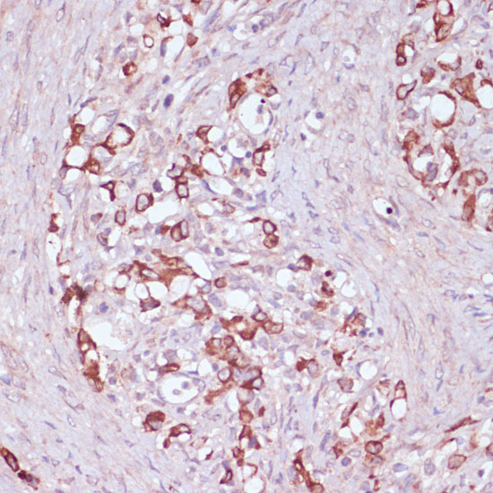 Immunohistochemistry of paraffin-embedded Human oophoroma using UGT2B15 Polyclonal Antibody at dilution of  1:100 (40x lens).