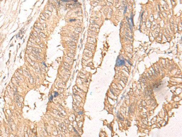 Immunohistochemistry of paraffin-embedded Human colorectal cancer tissue  using IL24 Polyclonal Antibody at dilution of 1:30(?200)