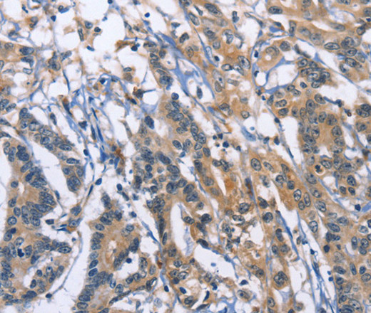 Immunohistochemistry of paraffin-embedded Human colon cancer using SYT17 Polyclonal Antibody at dilution of 1:60