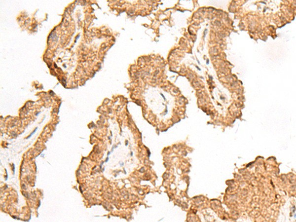 Immunohistochemistry of paraffin-embedded Human thyroid cancer tissue  using FGF13 Polyclonal Antibody at dilution of 1:45(?200)