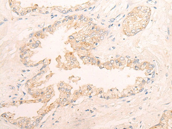 Immunohistochemistry of paraffin-embedded Human prost ate cancer tissue  using ELANE Polyclonal Antibody at dilution of 1:25(?200)