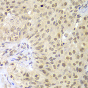 Immunohistochemistry of paraffin-embedded Human oophoroma using LHX4 Polyclonal Antibody at dilution of 1:100 (40x lens).
