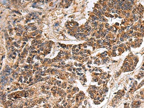 Immunohistochemistry of paraffin-embedded Human colorectal cancer tissue  using GANAB Polyclonal Antibody at dilution of 1:30(?200)