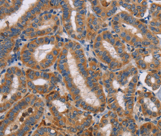 Immunohistochemistry of paraffin-embedded Human thyroid cancer tissue using TLR8 Polyclonal Antibody at dilution 1:40