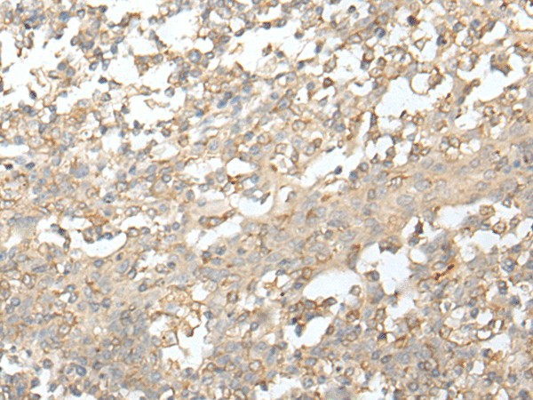 Immunohistochemistry of paraffin-embedded Human tonsil tissue  using ZZZ3 Polyclonal Antibody at dilution of 1:50(?200)