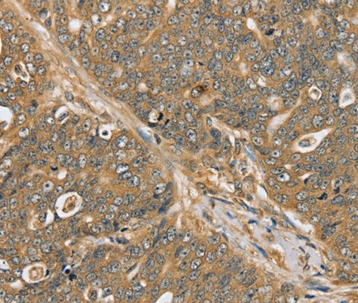 Immunohistochemistry of paraffin-embedded Human ovarian cancer using PTPN20 Polyclonal Antibody at dilution of 1:30