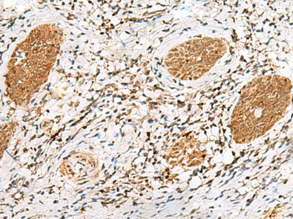 Immunohistochemistry of paraffin-embedded Human esophagus cancer tissue  using NUP58 Polyclonal Antibody at dilution of 1:60(?200)