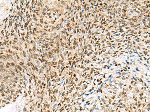 Immunohistochemistry of paraffin-embedded Human cervical cancer tissue  using UBLCP1 Polyclonal Antibody at dilution of 1:85(?200)