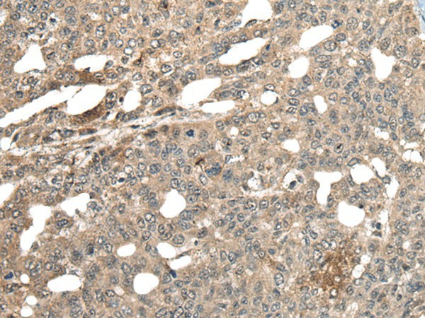 Immunohistochemistry of paraffin-embedded Human liver cancer tissue  using MCPH1 Polyclonal Antibody at dilution of 1:110(?200)