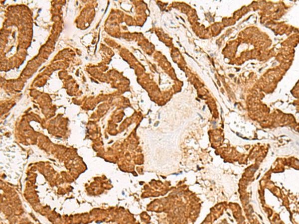 Immunohistochemistry of paraffin-embedded Human thyroid cancer tissue  using GMEB2 Polyclonal Antibody at dilution of 1:35(?200)