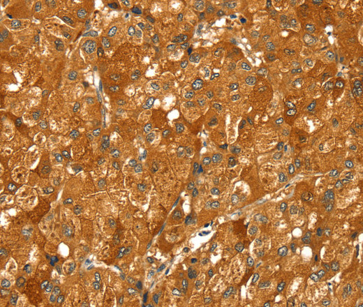 Immunohistochemistry of paraffin-embedded Human liver cancer using PYGM Polyclonal Antibody at dilution of 1:30