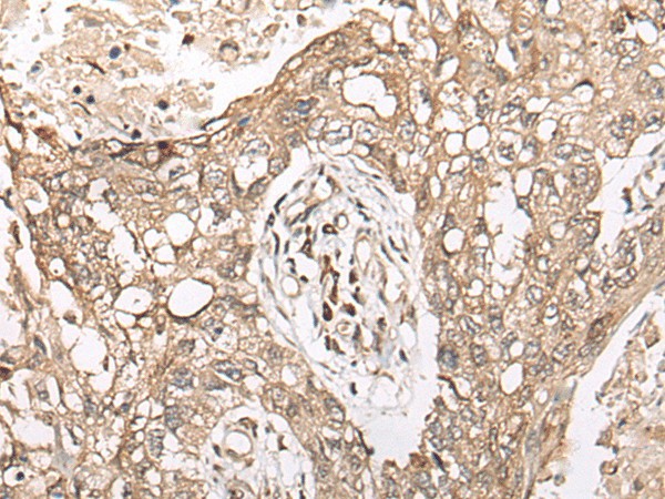 Immunohistochemistry of paraffin-embedded Human lung cancer tissue  using M1AP Polyclonal Antibody at dilution of 1:45(?200)