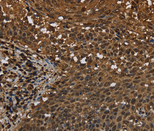 Immunohistochemistry of paraffin-embedded Human cervical cancer tissue using MYBBP1A Polyclonal Antibody at dilution 1:40