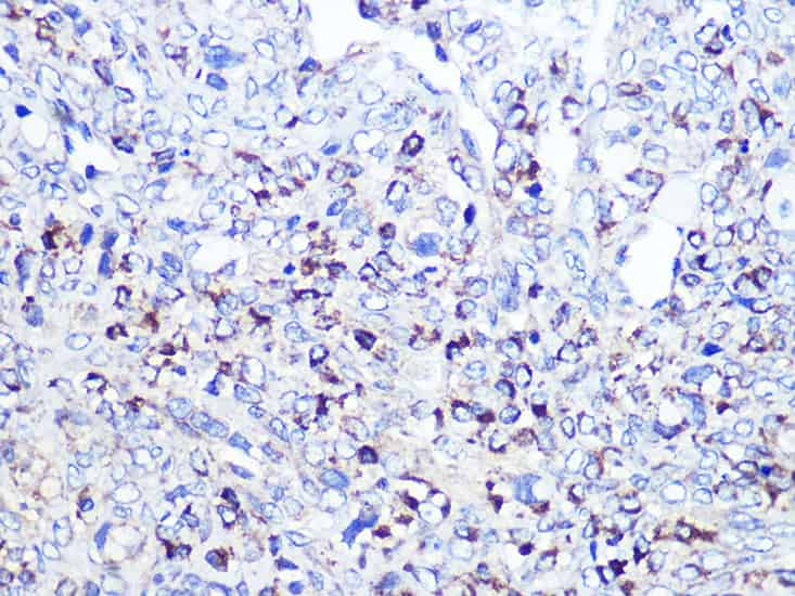 Immunohistochemistry of paraffin-embedded Human oophoroma using CD68 Polyclonal Antibody at dilution of  1:100 (40x lens).