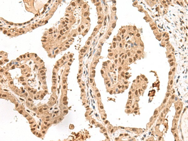 Immunohistochemistry of paraffin-embedded Human thyroid cancer tissue  using LGALS4 Polyclonal Antibody at dilution of 1:30(?200)