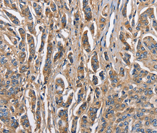 Immunohistochemistry of paraffin-embedded Human prostate cancer tissue using ABI3BP Polyclonal Antibody at dilution 1:60