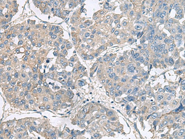 Immunohistochemistry of paraffin-embedded Human liver cancer tissue  using NPHP1 Polyclonal Antibody at dilution of 1:75(?200)