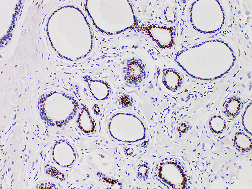 Immunohistochemistry of paraffinembedded Human breast cancer tissue with Progesterone Receptor(PR) Monoclonal Antibody(Antigen repaired by EDTA).