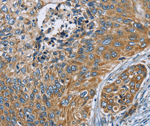 Immunohistochemistry of paraffin-embedded Human cervical cancer tissue using ZMYND11 Polyclonal Antibody at dilution 1:70