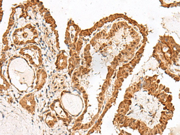 Immunohistochemistry of paraffin-embedded Human thyroid cancer tissue  using GRASP Polyclonal Antibody at dilution of 1:150(?200)