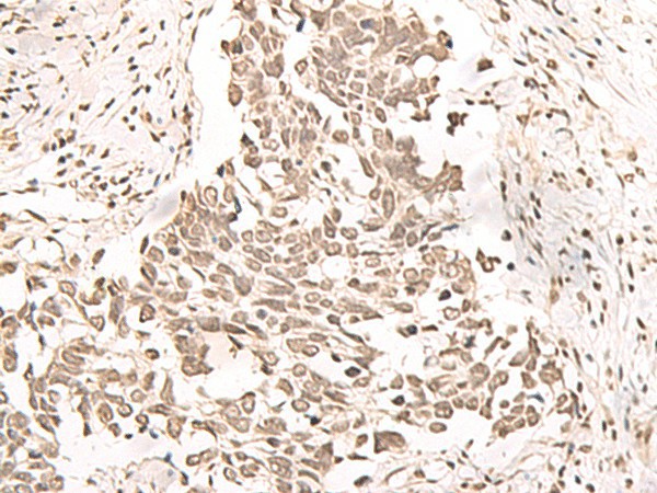 Immunohistochemistry of paraffin-embedded Human lung cancer tissue  using RRP1 Polyclonal Antibody at dilution of 1:40(?200)