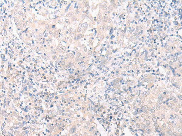 Immunohistochemistry of paraffin-embedded Human cervical cancer tissue  using SLC25A27 Polyclonal Antibody at dilution of 1:30(?200)