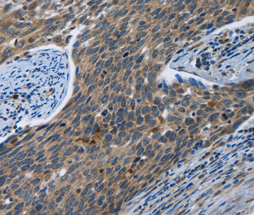 Immunohistochemistry of paraffin-embedded Human cervical cancer tissue using SYT3 Polyclonal Antibody at dilution 1:40