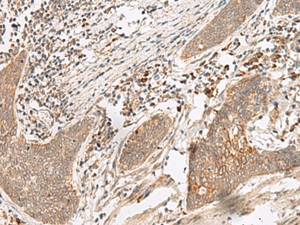 Immunohistochemistry of paraffin-embedded Human esophagus cancer tissue  using FUT10 Polyclonal Antibody at dilution of 1:45(?200)