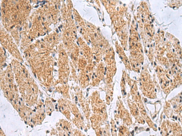 Immunohistochemistry of paraffin-embedded Human esophagus cancer tissue  using SLC4A3 Polyclonal Antibody at dilution of 1:35(?200)