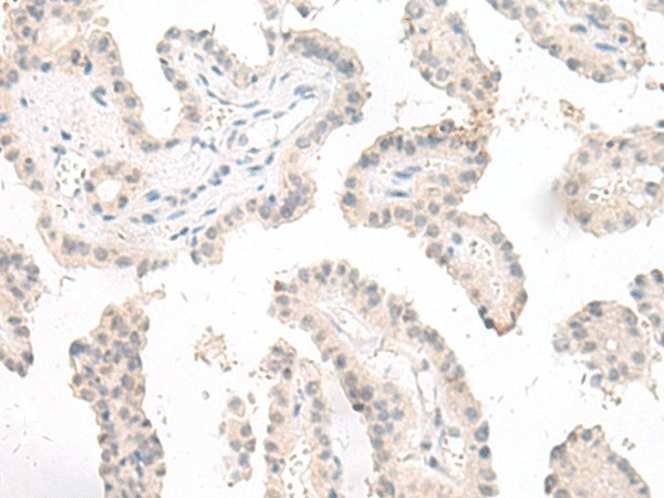 Immunohistochemistry of paraffin-embedded Human thyroid cancer tissue  using GHDC Polyclonal Antibody at dilution of 1:90(?200)